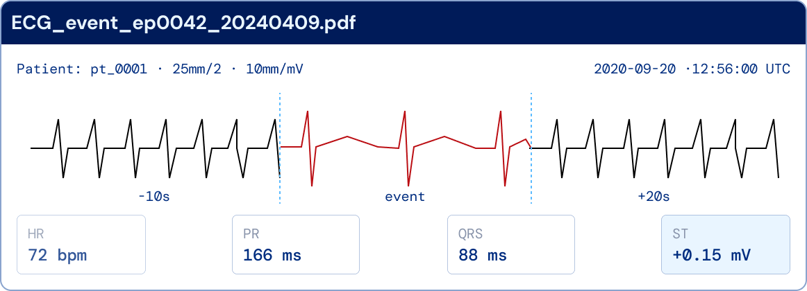 A telemetry strip PDF showing the waveform around a flagged event with ten seconds before and twenty after, plus HR, PR, QRS and ST measurements